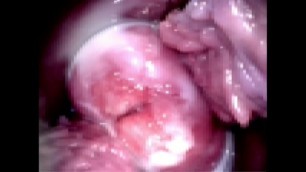 Cuzco's View of the Cervix and Vaginal Wall
